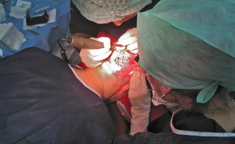 Micromotor en implantes foliculares