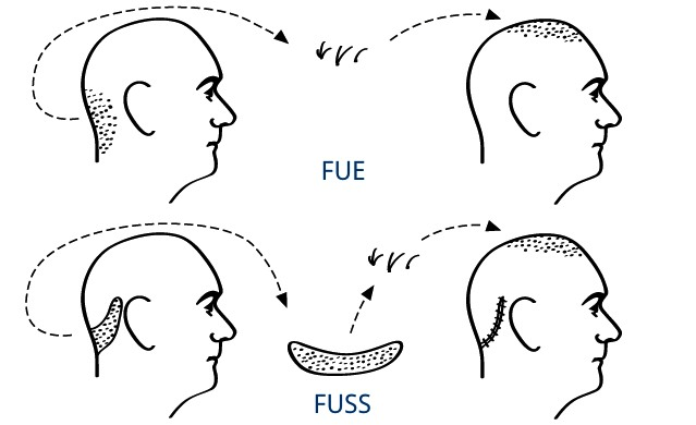 fue-o-fuss